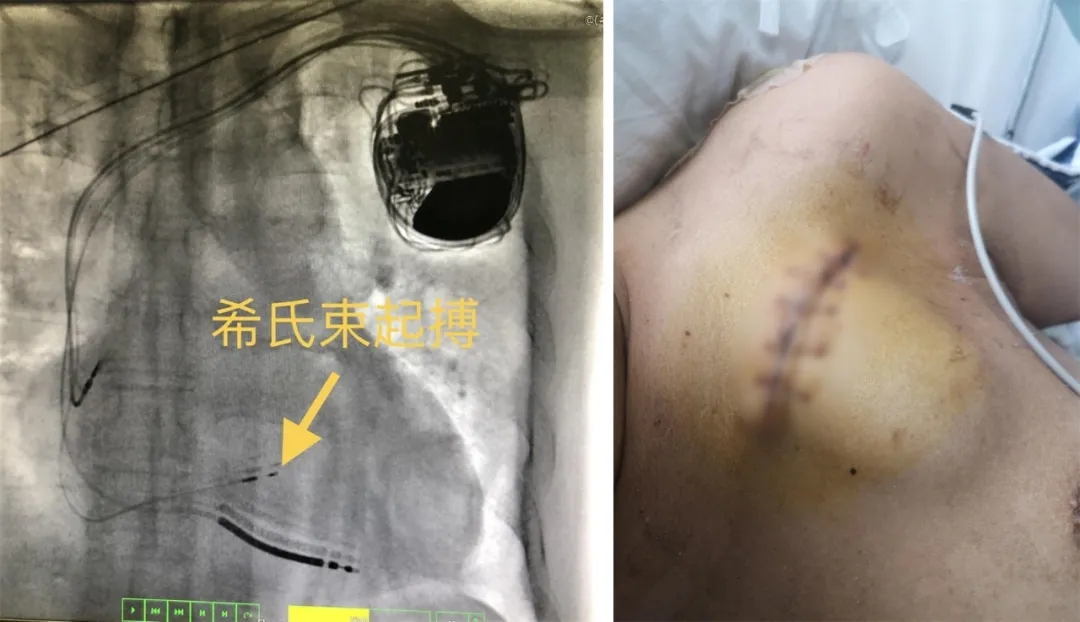 据悉,心脏再同步治疗起搏器(crt